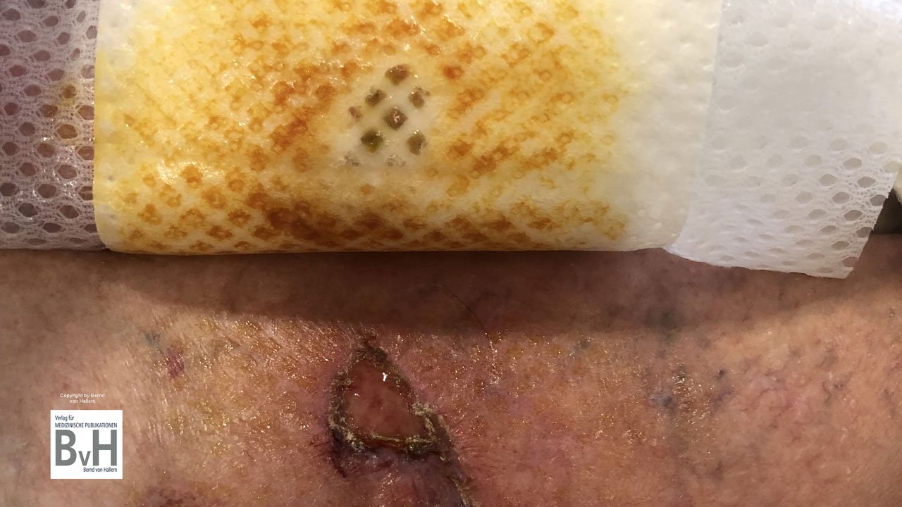 Ein semiokklusiver Verband auf einer infizierten Wunde ist grundsätzlich kontraindiziert