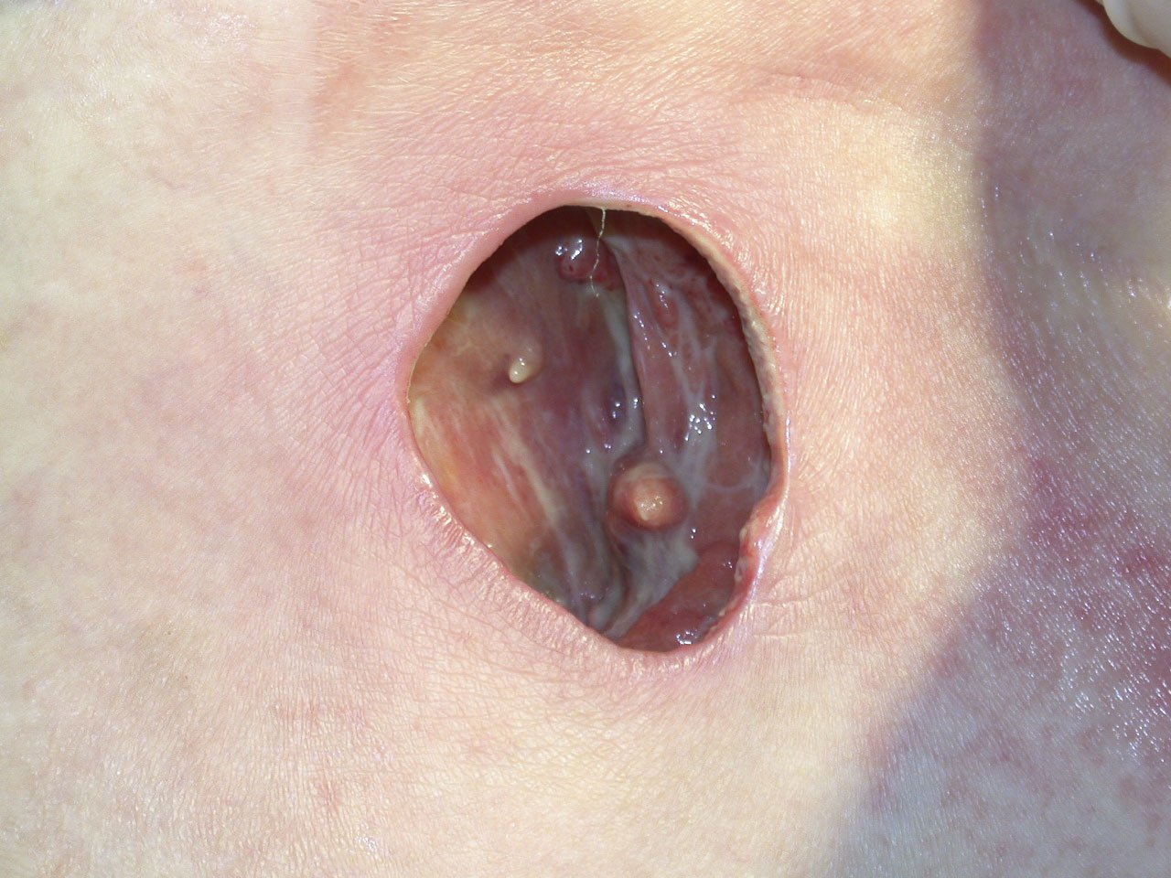 Alginate1 li Tiefer Dekubitus am Gesäß