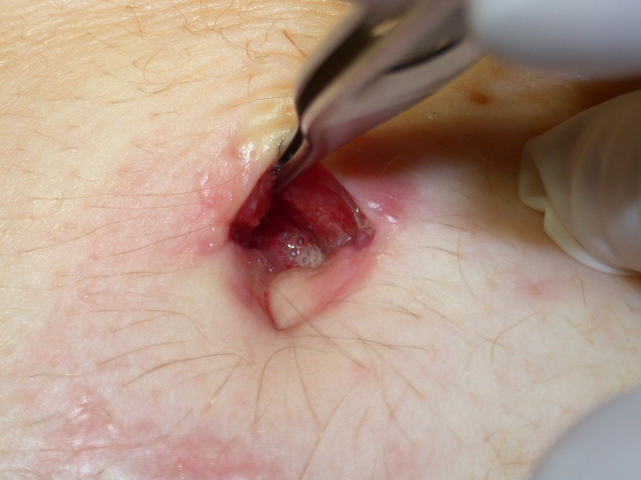 Alginate2 re Wundheilungsstörung postoperativ am Bauchnabel