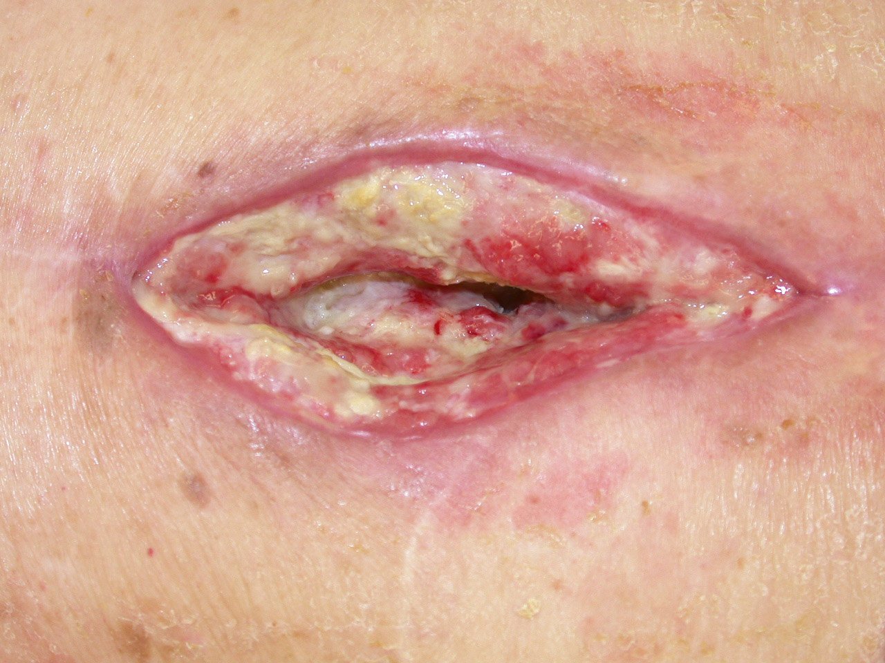 Bioakt.1 li Chronifizierte postoperative Wunde nach Wirbelsäulenstabilisierung