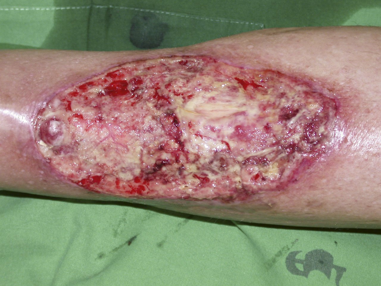 Bioakt.2 re Stagnierendes Ulcus cruris venosum
