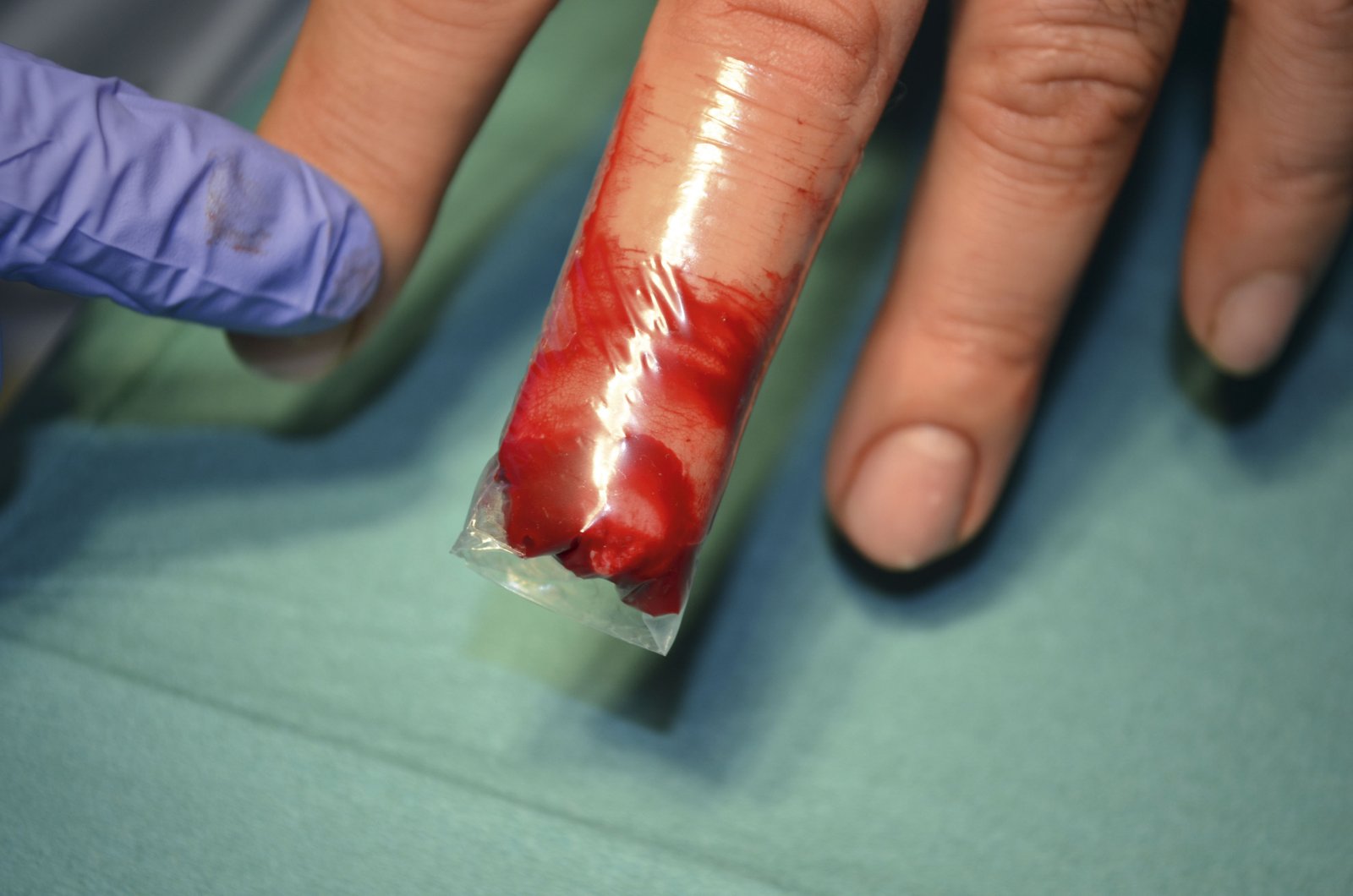 Folien1li Erstversorgung einer Fingerkuppenamputation mit einem Folienverband