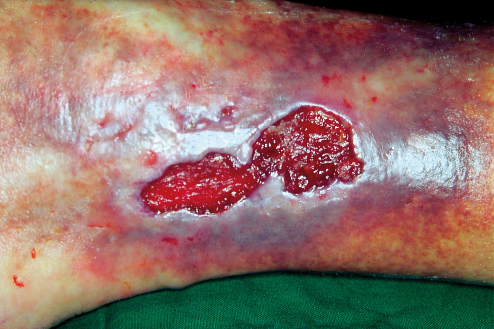 Hydrokolloide1li Gering exsudierendes Ulcus cruris venosum