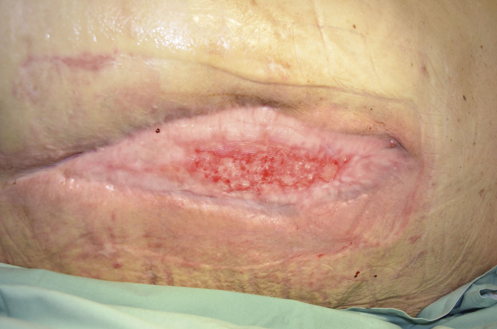 Hydrokolloide2re Gering exsudierende epithelisierende postoperative Wunde am Rücken