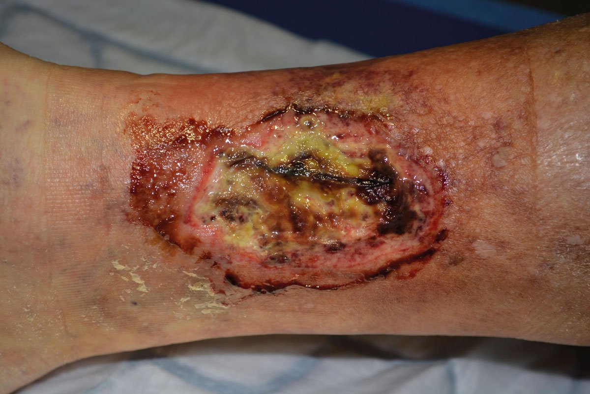 Wundreinigung2re Teils nekrotisch belegtes Ulcus cruris arteriosum